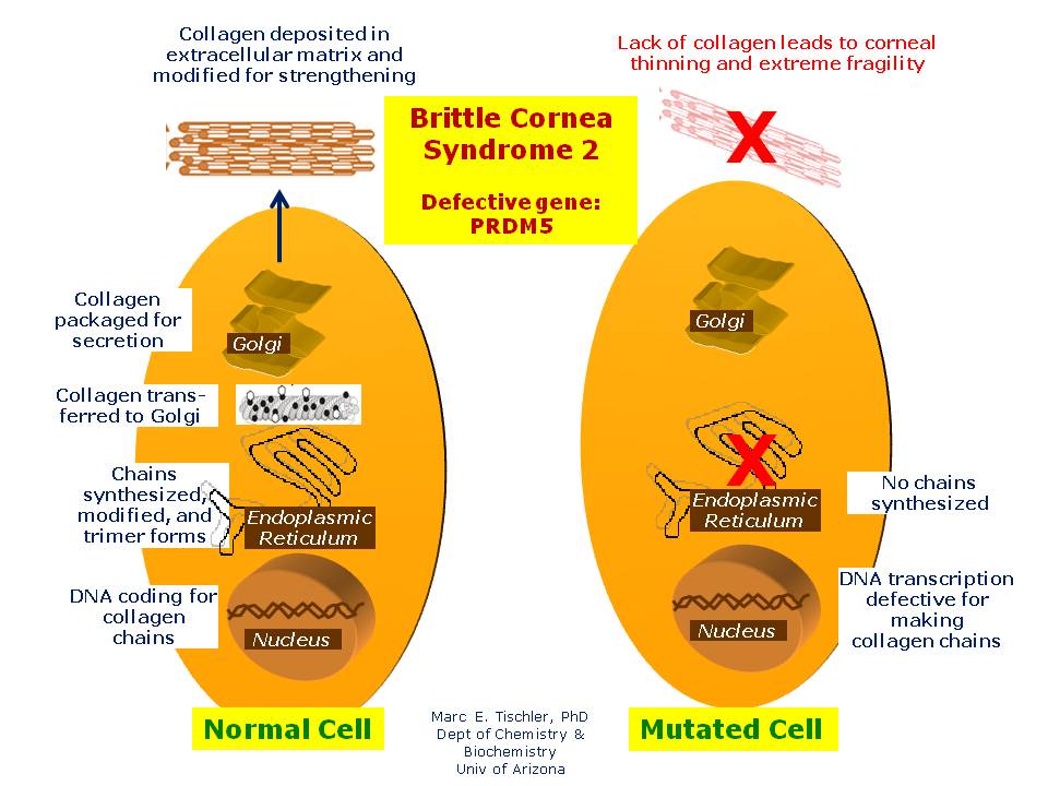 Brittle Cornea Syndrome 2 Hereditary Ocular Diseases
